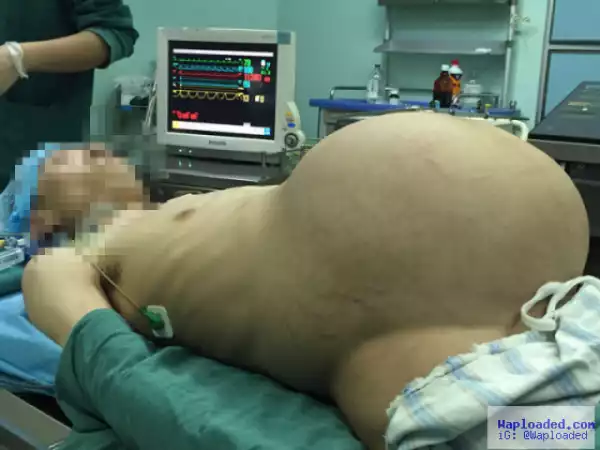 Photos: Doctors remove giant 15-kg tumor from man